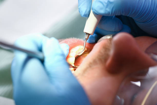 Best Emergency Wisdom Teeth Removal in Matoaca, VA